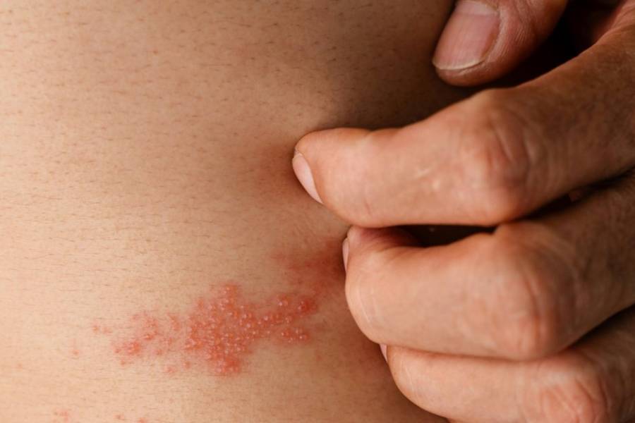 Preocupación por incremento de casos de Herpes Zoster