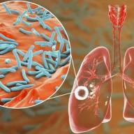 Alerta tuberculosis: se notificaron más de 13.000 casos en Argentina