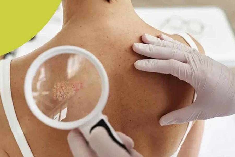 Jornada de prevención de cáncer de piel