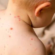 El Ministerio de Salud detectó un caso de sarampión en Entre Ríos y activó una alerta nacional
