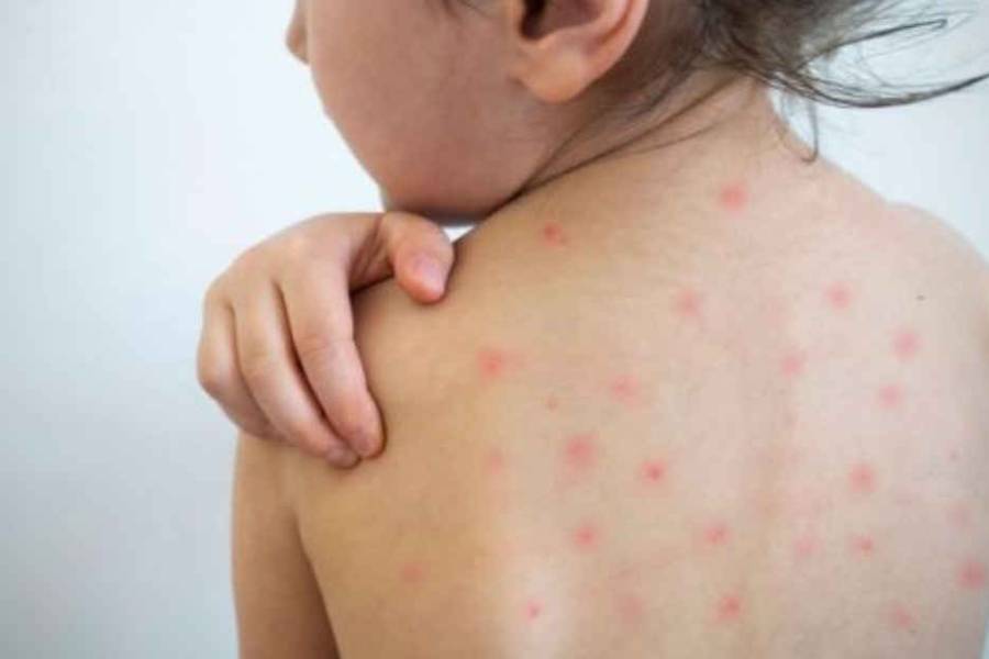 Alerta por primer caso de sarampión en Argentina: La vacunación es clave para proteger a la comunidad