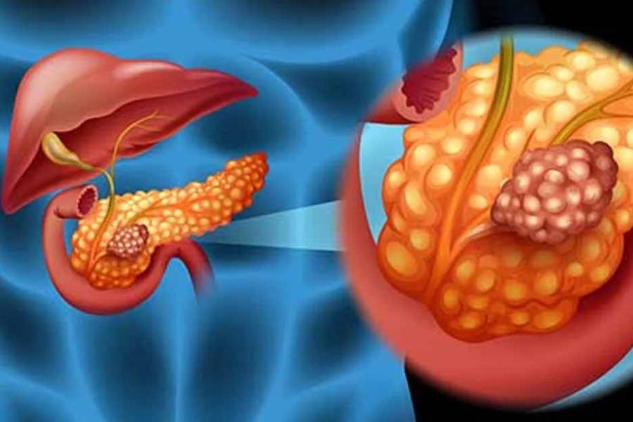 Cáncer de páncreas: científicos españoles lograron eliminarlo en un estudio con ratones