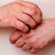 Alerta epidemiológica: confirman el primer caso de una variante más contagiosa y severa de la viruela símica