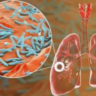 Tuberculosis: actualizaciones sobre una de las principales causas de muerte por agentes infecciosos