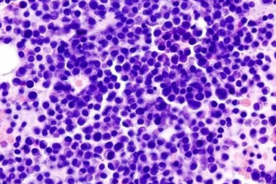 ANMAT aprueba un tratamiento para mieloma múltiple avanzado con pocas opciones terapéuticas