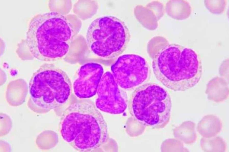 9 de cada 10 pacientes con leucemia linfocítica crónica no reconocen los síntomas antes del diagnóstico
