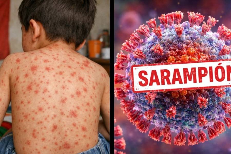 Recomendaciones y medidas de prevención por el Sarampión